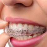 5 Surprising Things Invisalign Can Fix That Most People Don’t Know